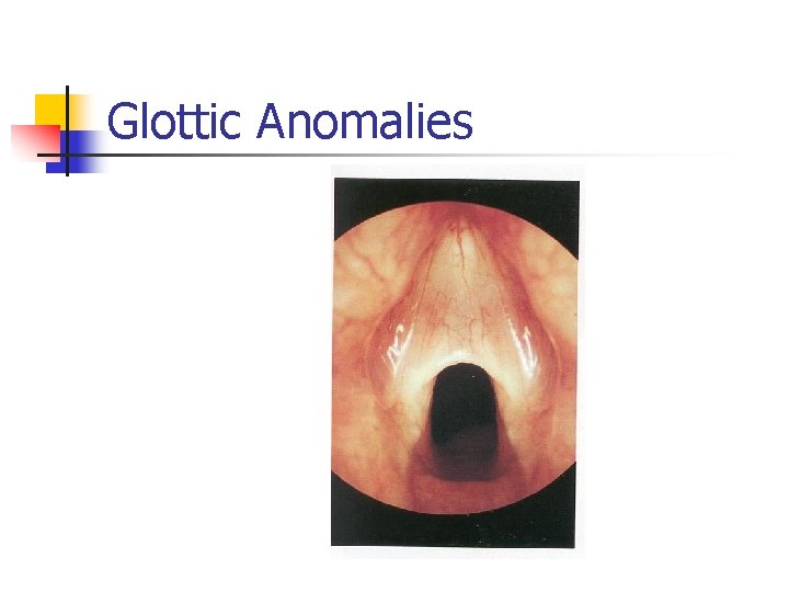 Glottic Anomalies 