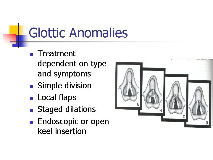 Glottic Anomalies n n n Treatment dependent on type and symptoms Simple division Local