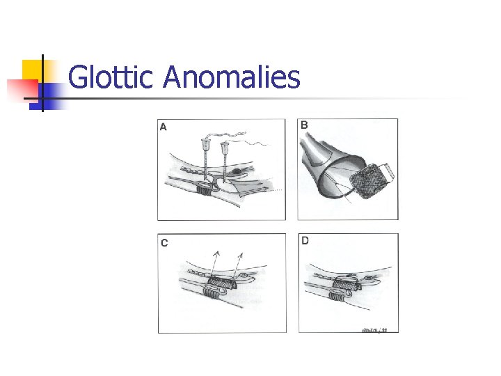 Glottic Anomalies 