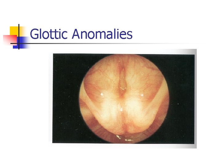 Glottic Anomalies 