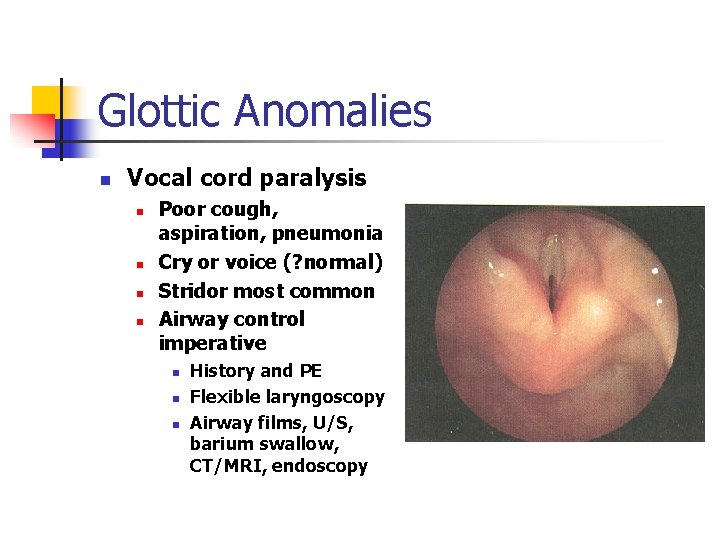 Glottic Anomalies n Vocal cord paralysis n n Poor cough, aspiration, pneumonia Cry or