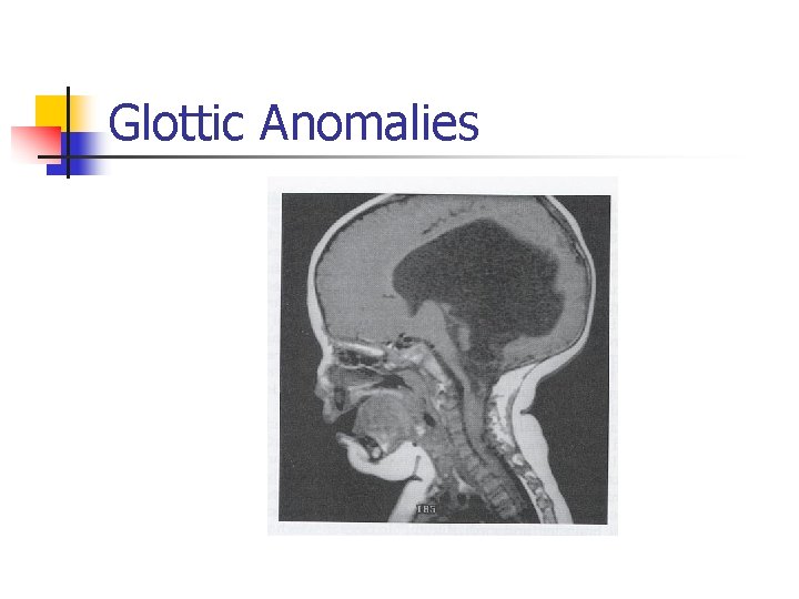 Glottic Anomalies 