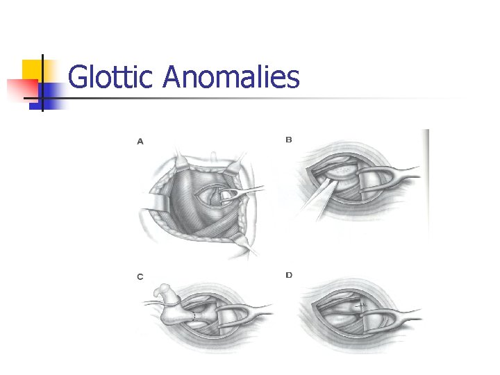 Glottic Anomalies 