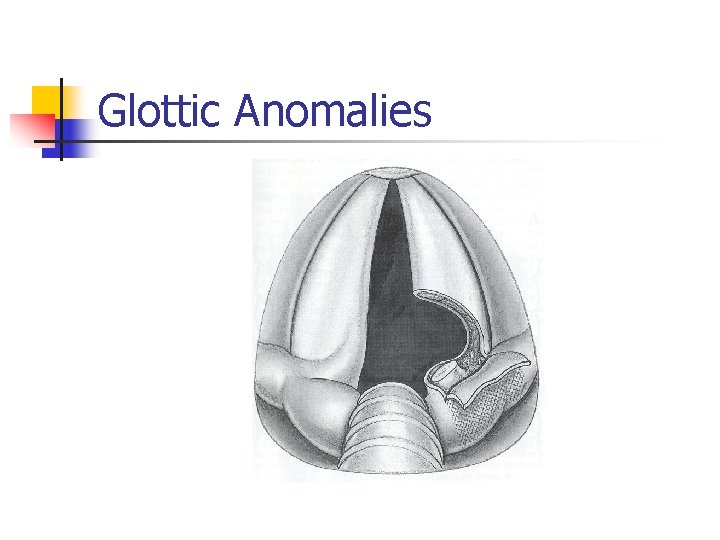 Glottic Anomalies 