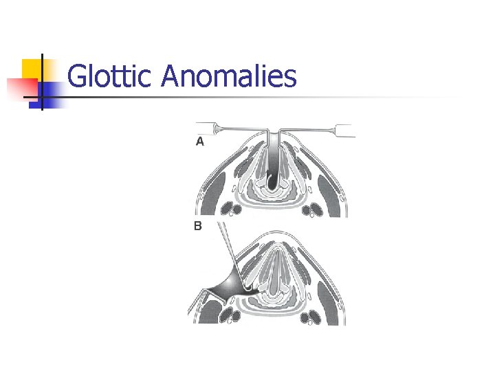 Glottic Anomalies 