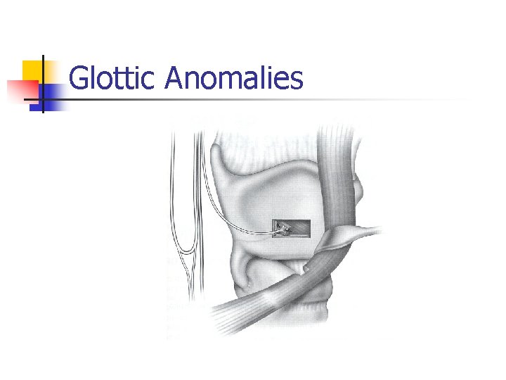 Glottic Anomalies 