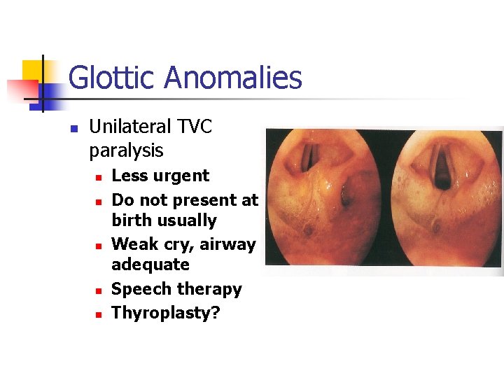 Glottic Anomalies n Unilateral TVC paralysis n n n Less urgent Do not present
