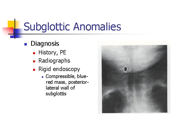 Subglottic Anomalies n Diagnosis n n n History, PE Radiographs Rigid endoscopy n Compressible,