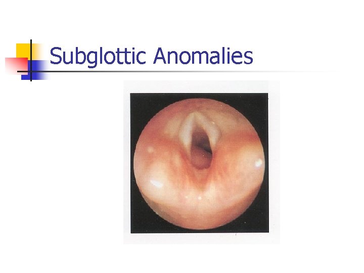 Subglottic Anomalies 