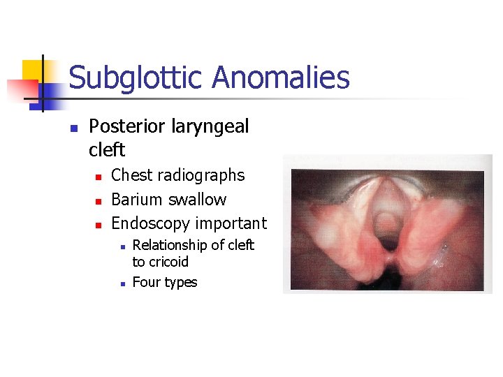 Subglottic Anomalies n Posterior laryngeal cleft n n n Chest radiographs Barium swallow Endoscopy