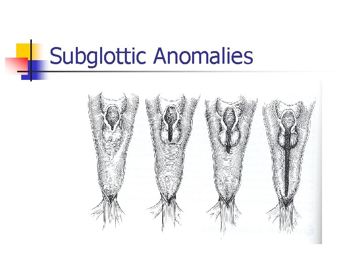 Subglottic Anomalies 