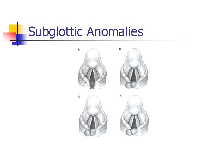 Subglottic Anomalies 