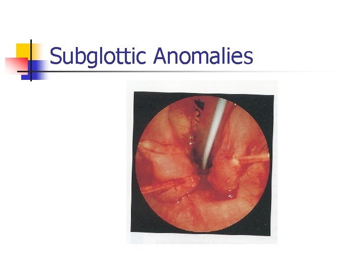 Subglottic Anomalies 