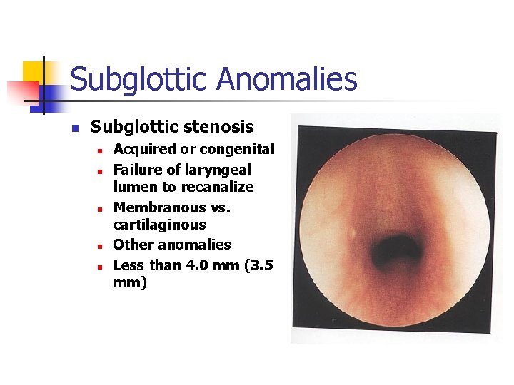 Subglottic Anomalies n Subglottic stenosis n n n Acquired or congenital Failure of laryngeal