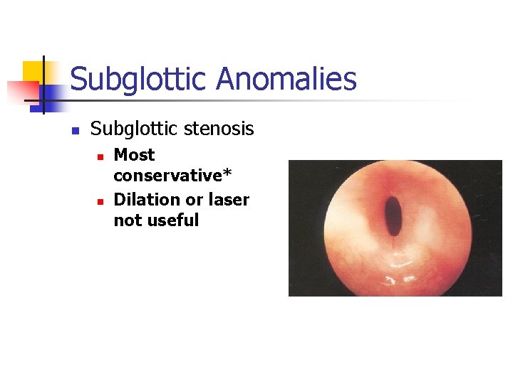 Subglottic Anomalies n Subglottic stenosis n n Most conservative* Dilation or laser not useful