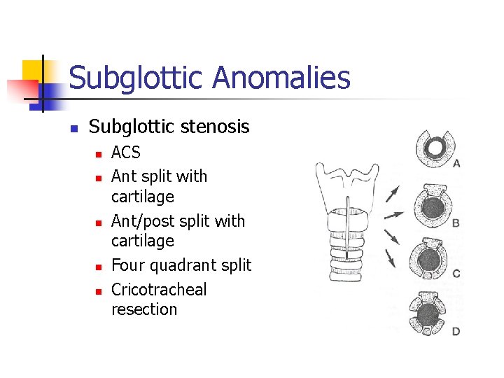 Subglottic Anomalies n Subglottic stenosis n n n ACS Ant split with cartilage Ant/post