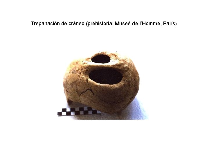 Trepanación de cráneo (prehistoria; Museé de l’Homme, París) 