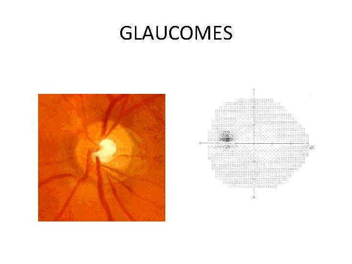 GLAUCOMES 