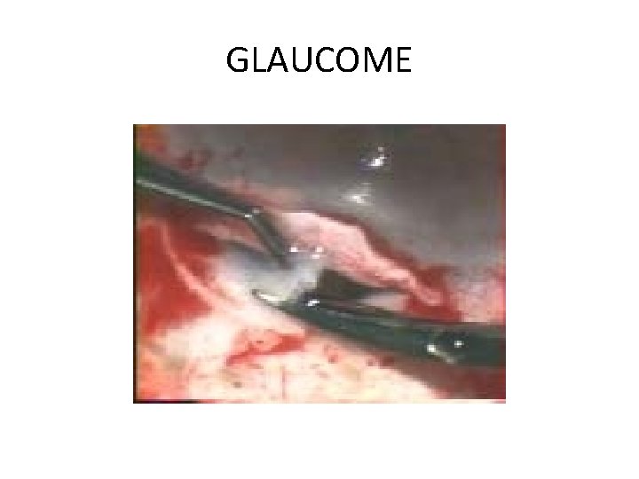 GLAUCOME 