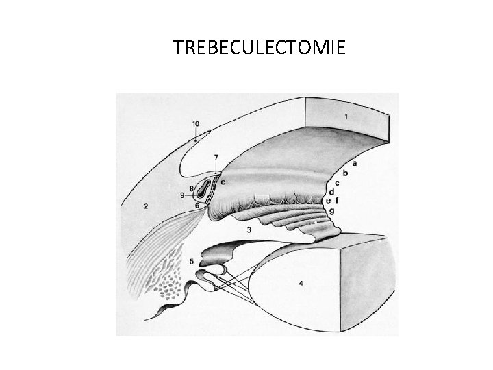 TREBECULECTOMIE 