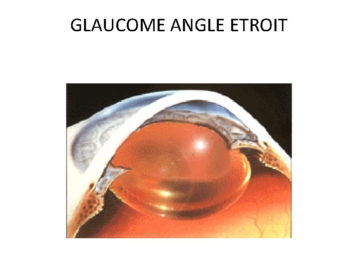 GLAUCOME ANGLE ETROIT 