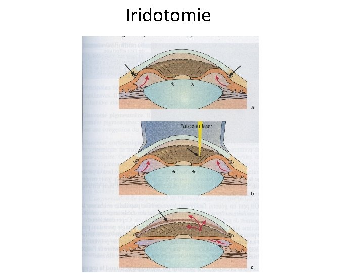 Iridotomie 