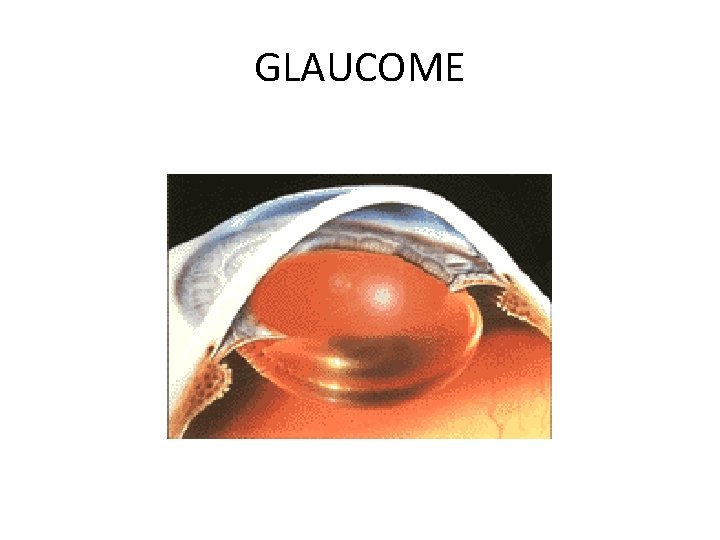 GLAUCOME 
