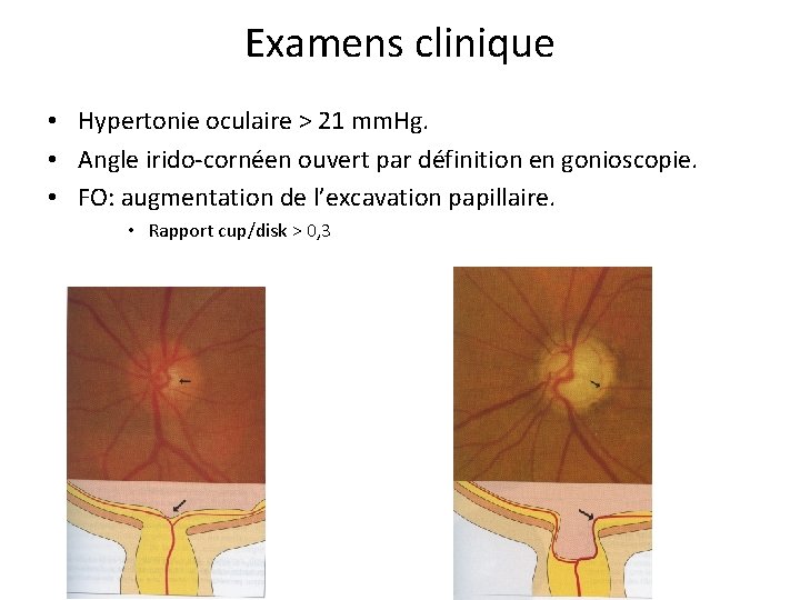 Examens clinique • Hypertonie oculaire > 21 mm. Hg. • Angle irido-cornéen ouvert par