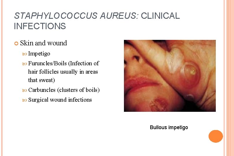 STAPHYLOCOCCUS AUREUS: CLINICAL INFECTIONS Skin and wound Impetigo Furuncles/Boils (Infection of hair follicles usually