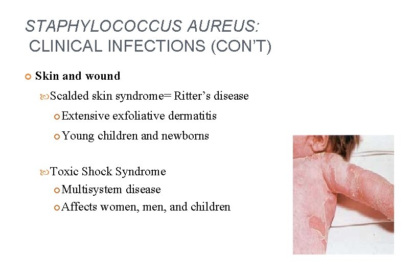STAPHYLOCOCCUS AUREUS: CLINICAL INFECTIONS (CON’T) Skin and wound Scalded skin syndrome= Ritter’s disease Extensive