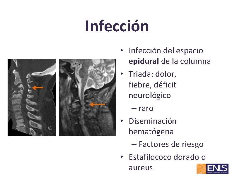 Infección • Infección del espacio epidural de la columna • Triada: dolor, fiebre, déficit