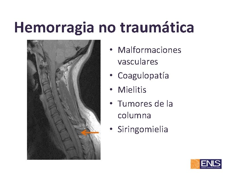 Hemorragia no traumática • Malformaciones vasculares • Coagulopatía • Mielitis • Tumores de la