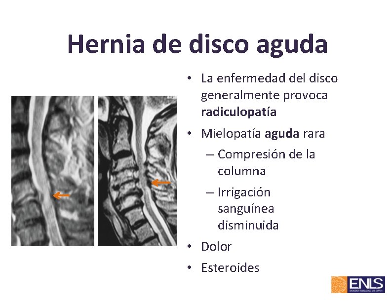 Hernia de disco aguda • La enfermedad del disco generalmente provoca radiculopatía • Mielopatía