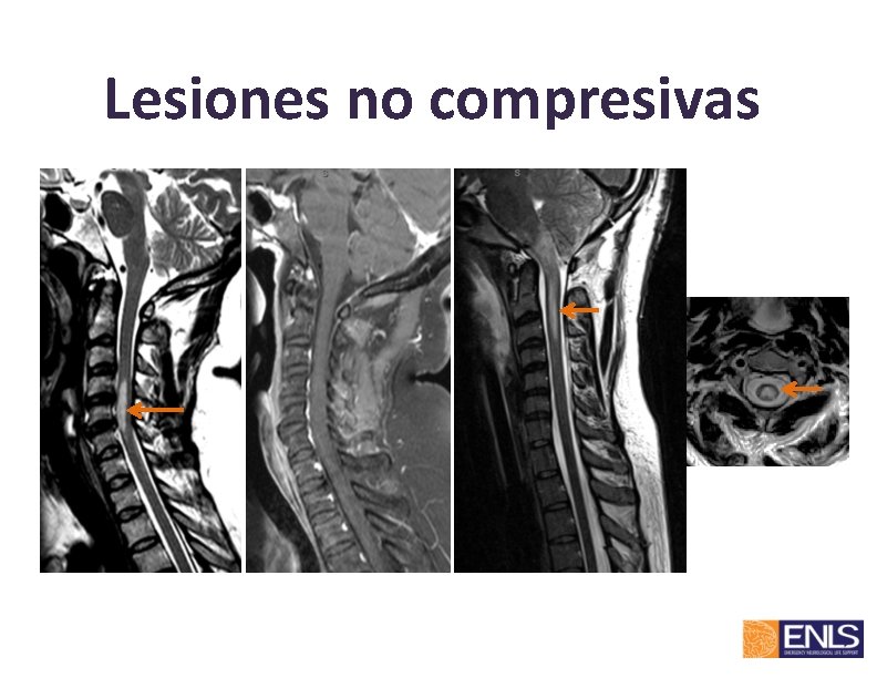 Lesiones no compresivas 