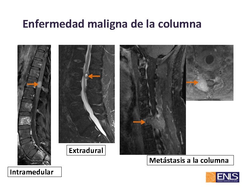Enfermedad maligna de la columna Extradural Metástasis a la columna Intramedular 