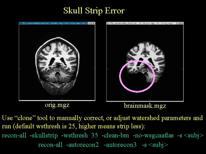 Skull Strip Error orig. mgz brainmask. mgz Use “clone” tool to manually correct, or