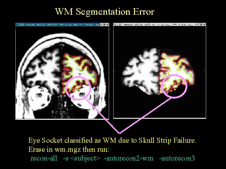 WM Segmentation Error Eye Socket classified as WM due to Skull Strip Failure. Erase