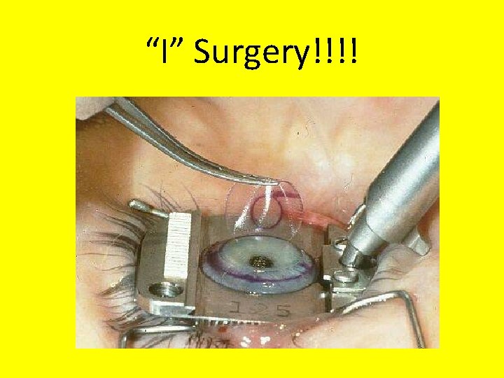 “I” Surgery!!!! 