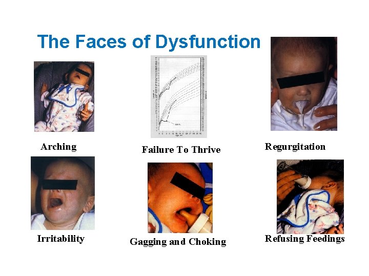 The Faces of Dysfunction Arching Irritability Failure To Thrive Gagging and Choking Regurgitation Refusing