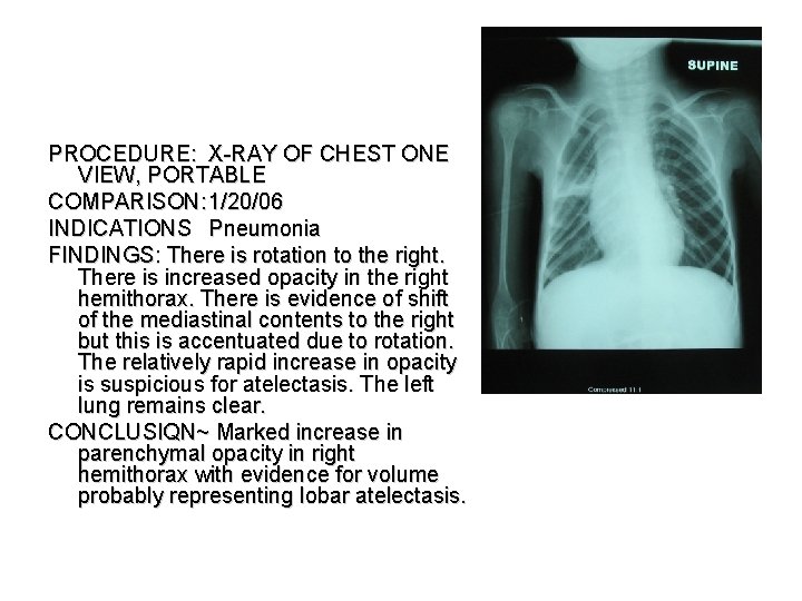 PROCEDURE: X-RAY OF CHEST ONE VIEW, PORTABLE COMPARISON: 1/20/06 INDICATIONS Pneumonia FINDINGS: There is