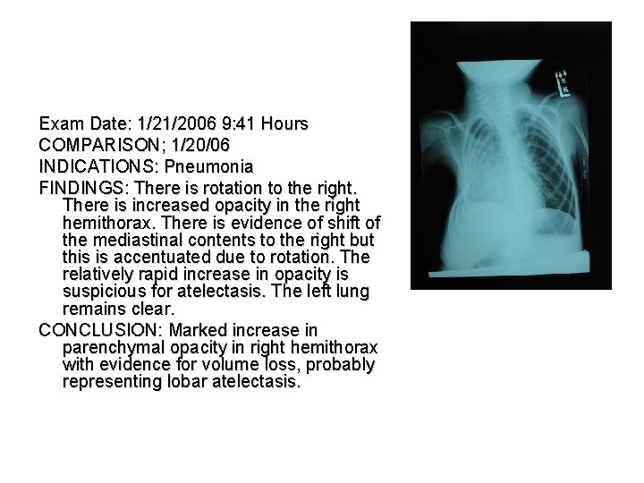 Exam Date: 1/21/2006 9: 41 Hours COMPARISON; 1/20/06 INDICATIONS: Pneumonia FINDINGS: There is rotation