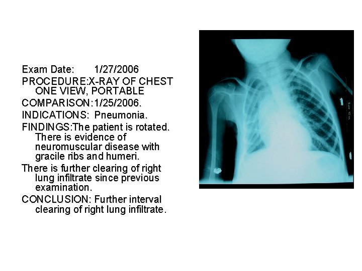 Exam Date: 1/27/2006 PROCEDURE: X-RAY OF CHEST ONE VIEW, PORTABLE COMPARISON: 1/25/2006. INDICATIONS: Pneumonia.
