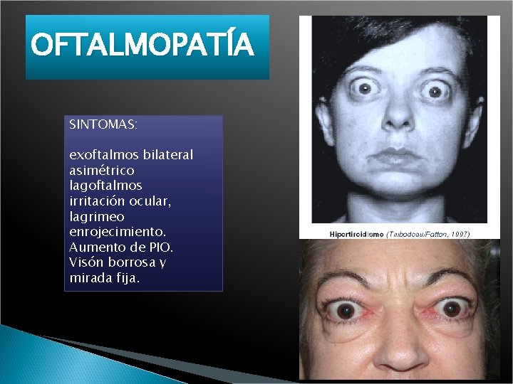 OFTALMOPATÍA SINTOMAS: exoftalmos bilateral asimétrico lagoftalmos irritación ocular, lagrimeo enrojecimiento. Aumento de PIO. Visón