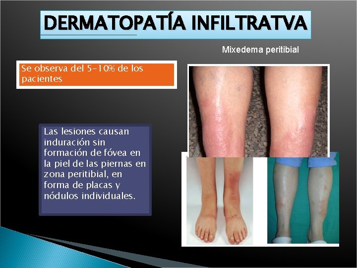 DERMATOPATÍA INFILTRATVA Mixedema peritibial Se observa del 5 -10% de los pacientes Las lesiones