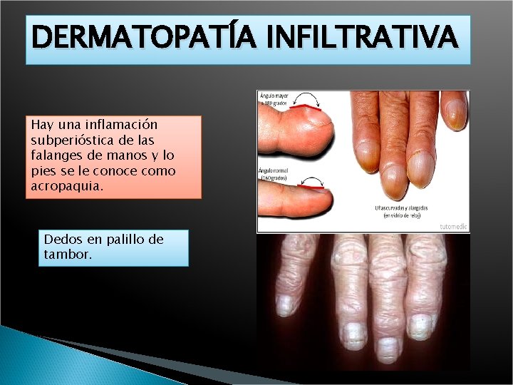 DERMATOPATÍA INFILTRATIVA Hay una inflamación subperióstica de las falanges de manos y lo pies