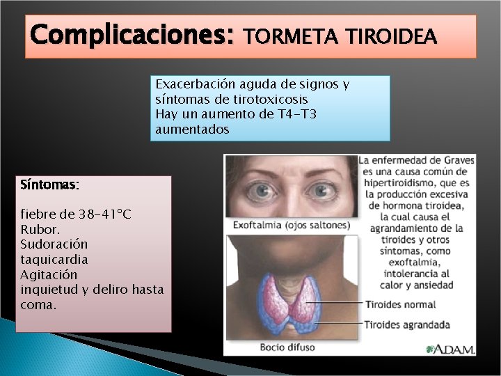 Complicaciones: TORMETA TIROIDEA Exacerbación aguda de signos y síntomas de tirotoxicosis Hay un aumento