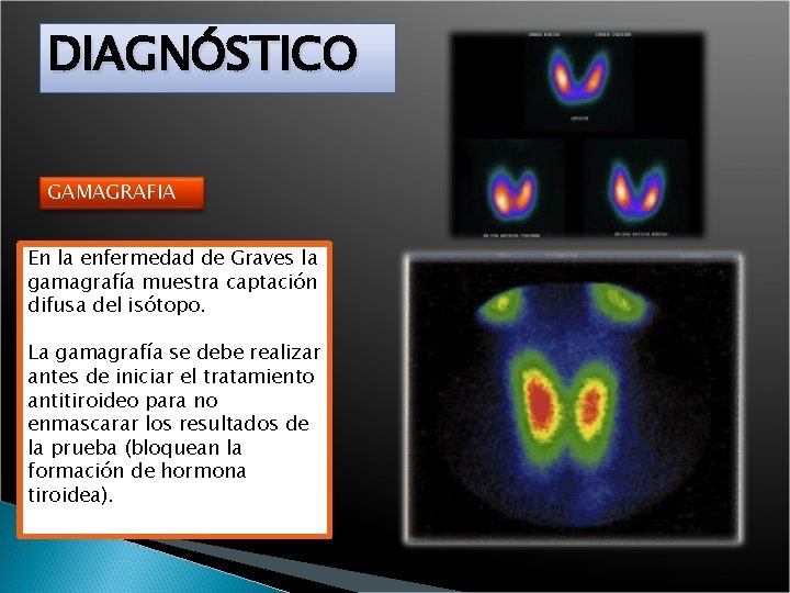 DIAGNÓSTICO GAMAGRAFIA En la enfermedad de Graves la gamagrafía muestra captación difusa del isótopo.