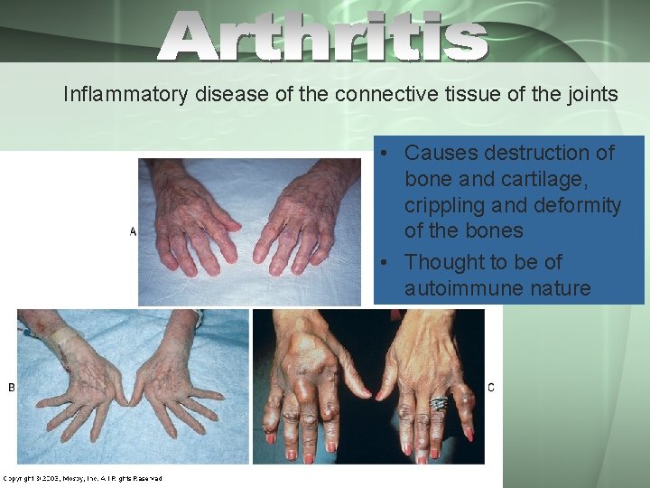 Inflammatory disease of the connective tissue of the joints • Causes destruction of bone