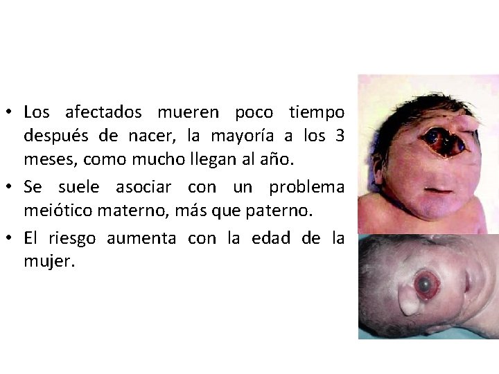  • Los afectados mueren poco tiempo después de nacer, la mayoría a los