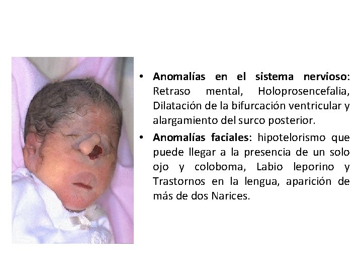  • Anomalías en el sistema nervioso: Retraso mental, Holoprosencefalia, Dilatación de la bifurcación